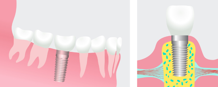 Artistic rendering of a dental implant with the post fused to the jawbone on the left and the implant topped with a dental crown on the right