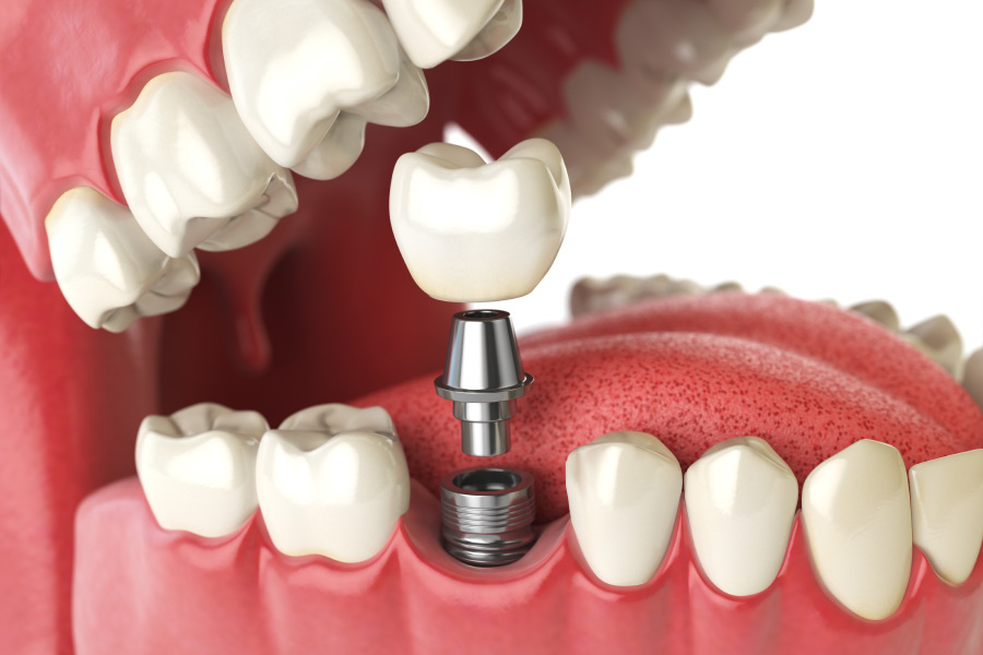 Closeup of a dental implant replacing a missing tooth