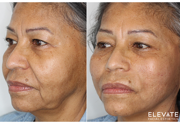 before and after PDO Thread treatment