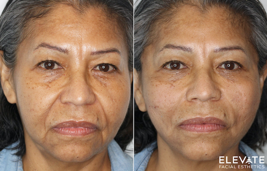 Middle-aged woman with a more youthful face after PDO thread lifts in Spanaway, WA