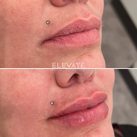 before/after faciel esthetics