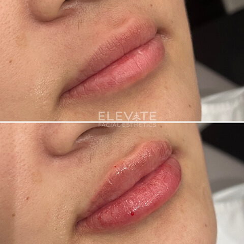 before/after faciel esthetics