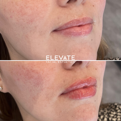 before/after faciel esthetics