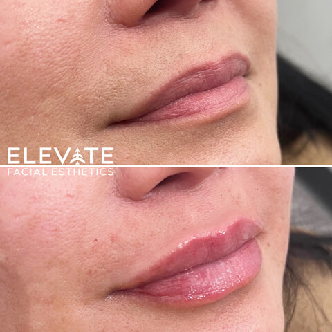 before/after faciel esthetics