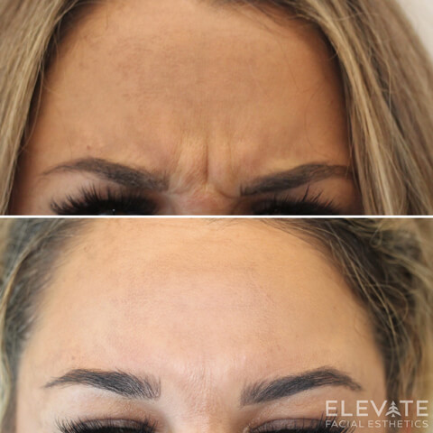 before/after faciel esthetics