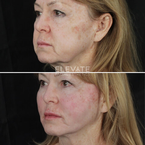 before/after faciel esthetics