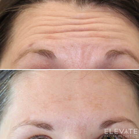 before/after faciel esthetics