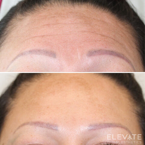 before/after faciel esthetics