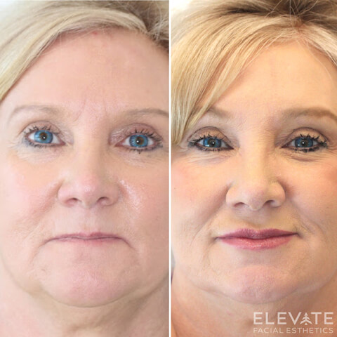 before/after faciel esthetics