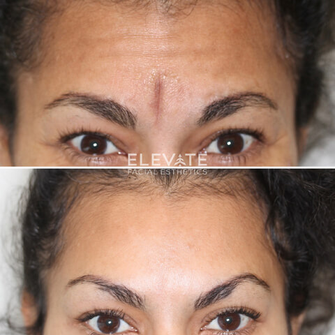 before/after faciel esthetics