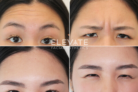 before/after faciel esthetics