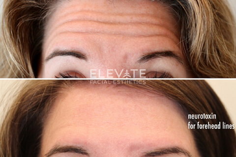 before/after faciel esthetics