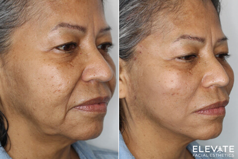 before/after faciel esthetics