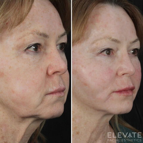 before/after faciel esthetics