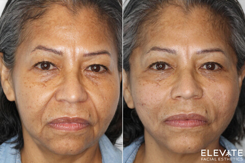 before/after faciel esthetics