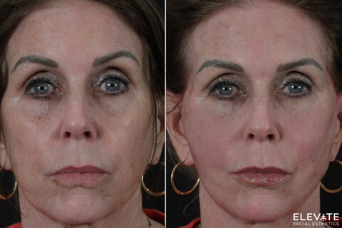 before/after faciel esthetics