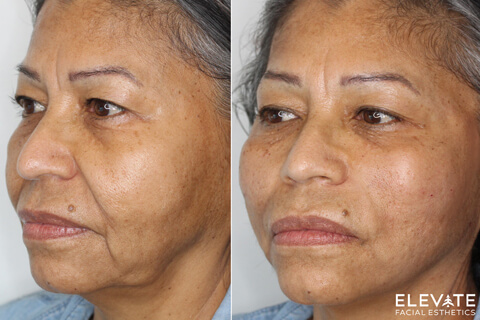 before/after faciel esthetics