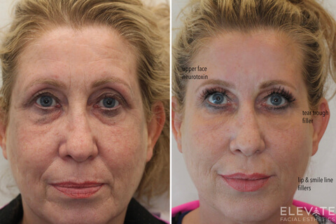 before/after faciel esthetics