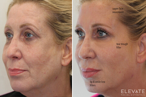 before/after faciel esthetics