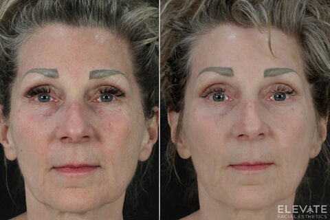 before/after faciel esthetics