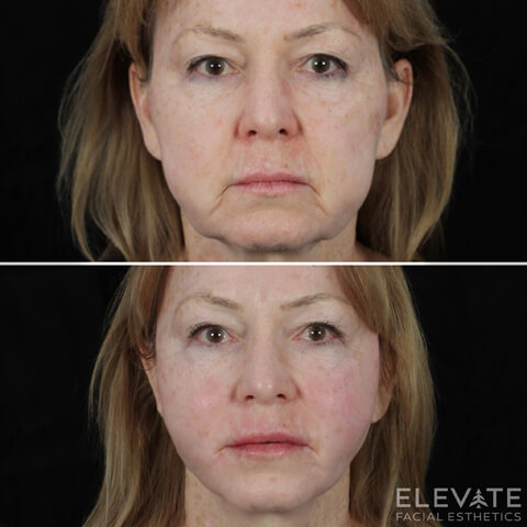 before/after faciel esthetics