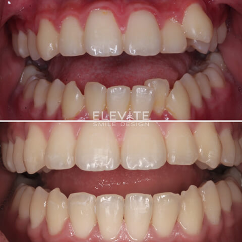 before/after orthodontic smiles