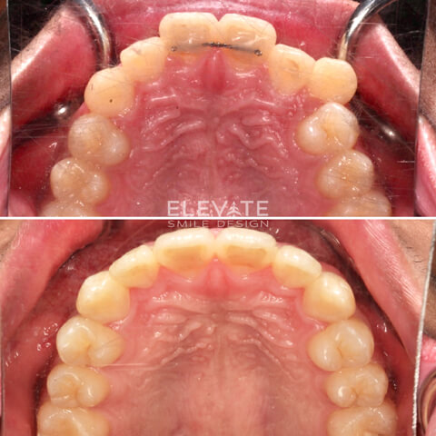 before/after orthodontic smiles