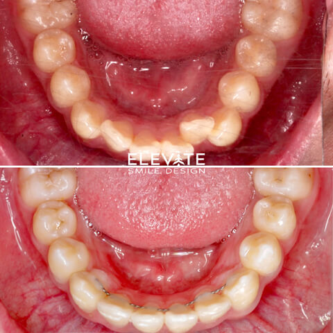 before/after orthodontic smiles