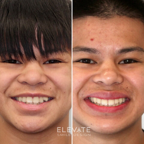 before/after orthodontic smiles