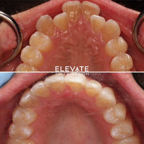 before/after orthodontic smiles