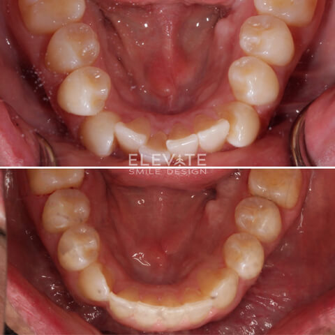 before/after orthodontic smiles