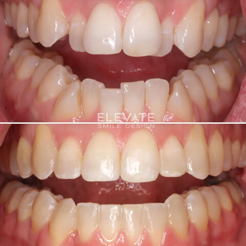 before/after orthodontic smiles