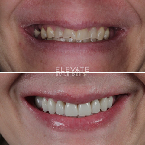 before/after smile transformation