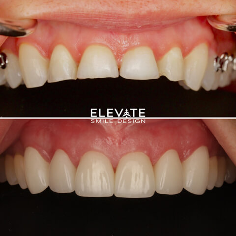 before/after smile transformation