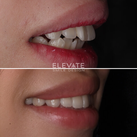 before/after smile transformation