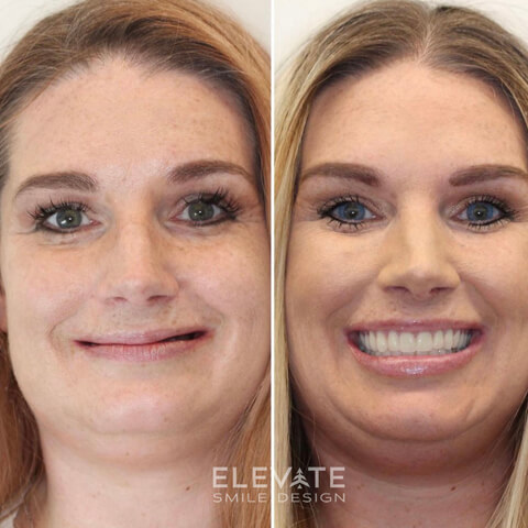 before/after smile transformation