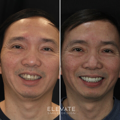 before/after smile transformation