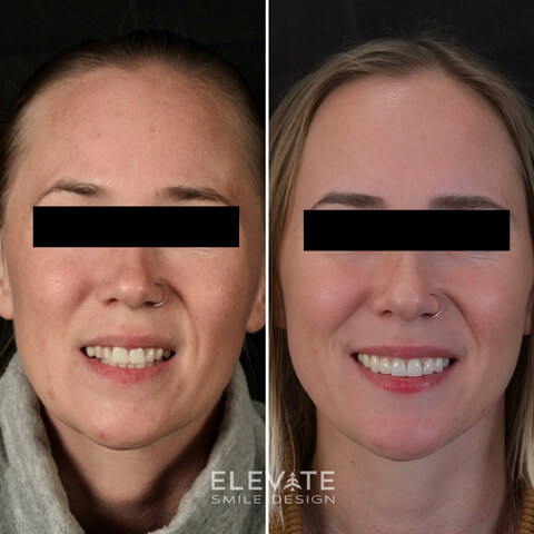 before/after smile transformation