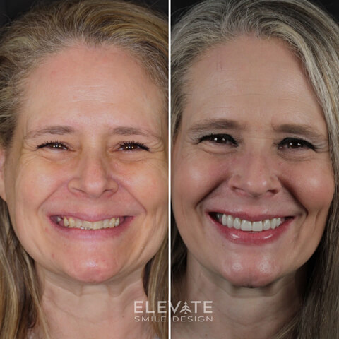 before/after smile transformation