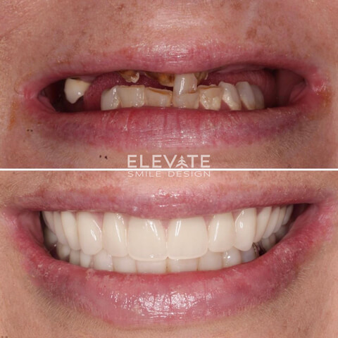 before/after smile transformation