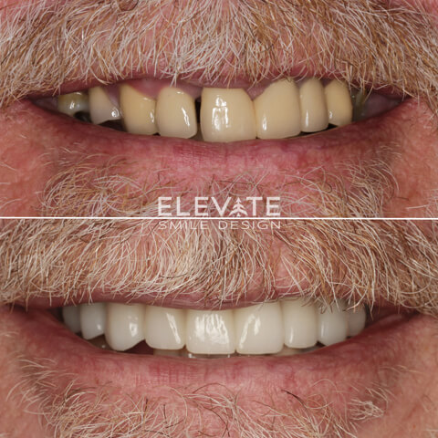 before/after smile transformation