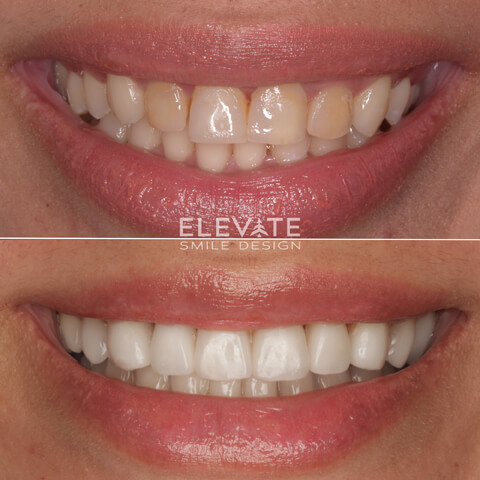 before/after smile transformation