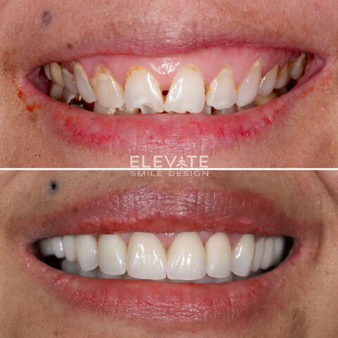 before/after smile transformation