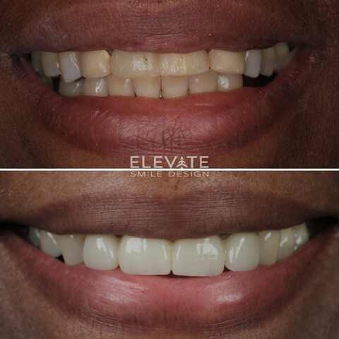 before/after smile transformation