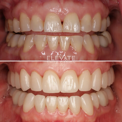 before/after smile transformation