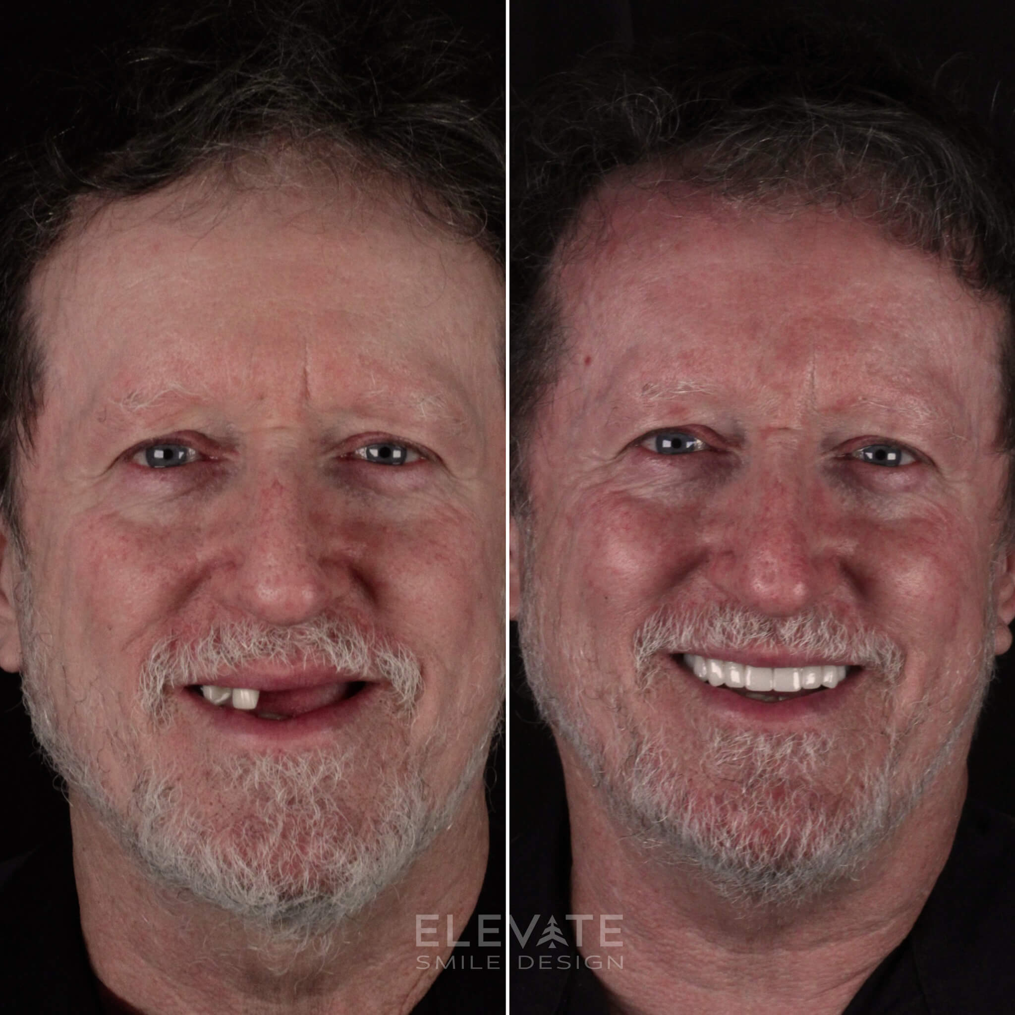 before/after smile transformation