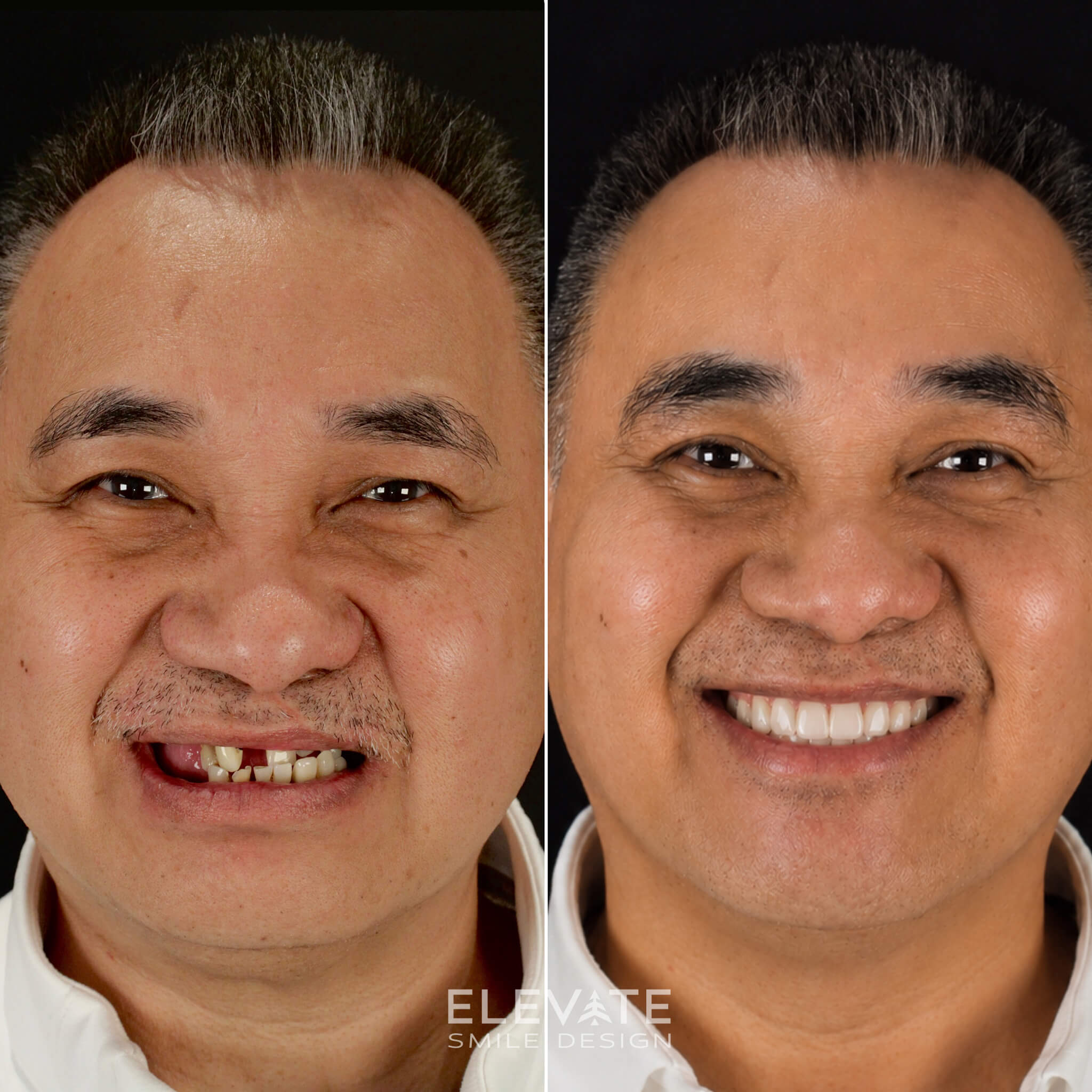 before/after smile transformation