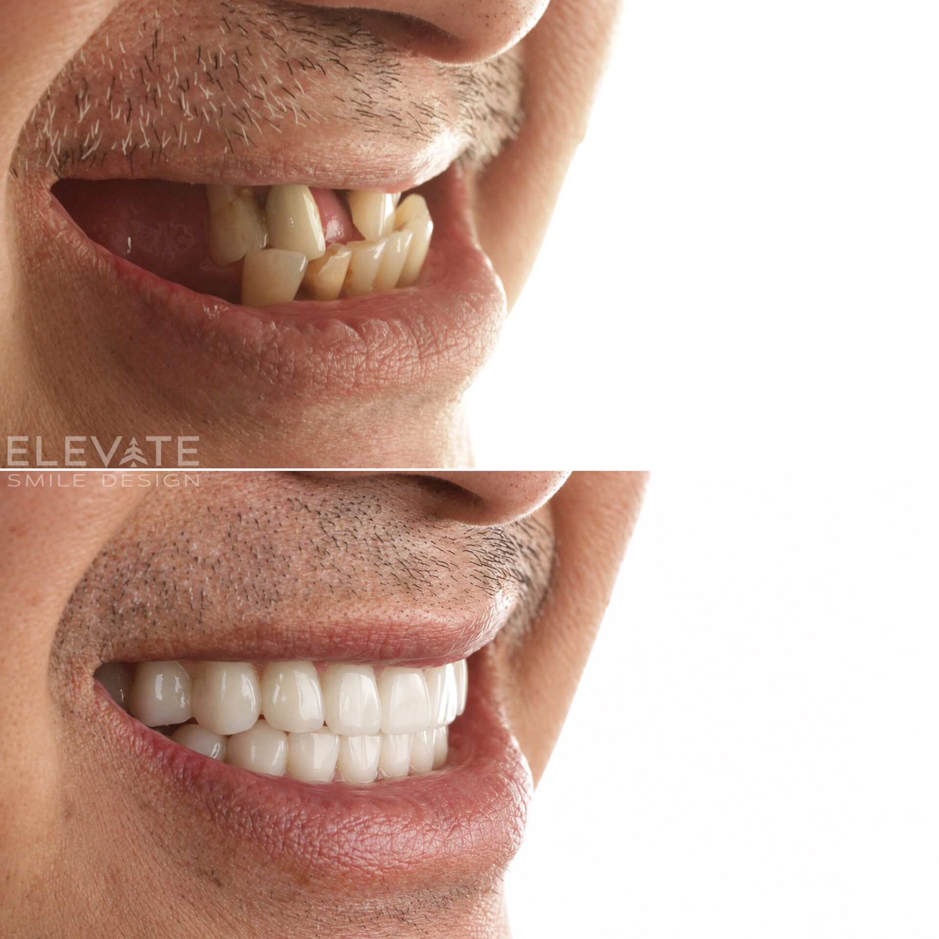 before/after smile transformation