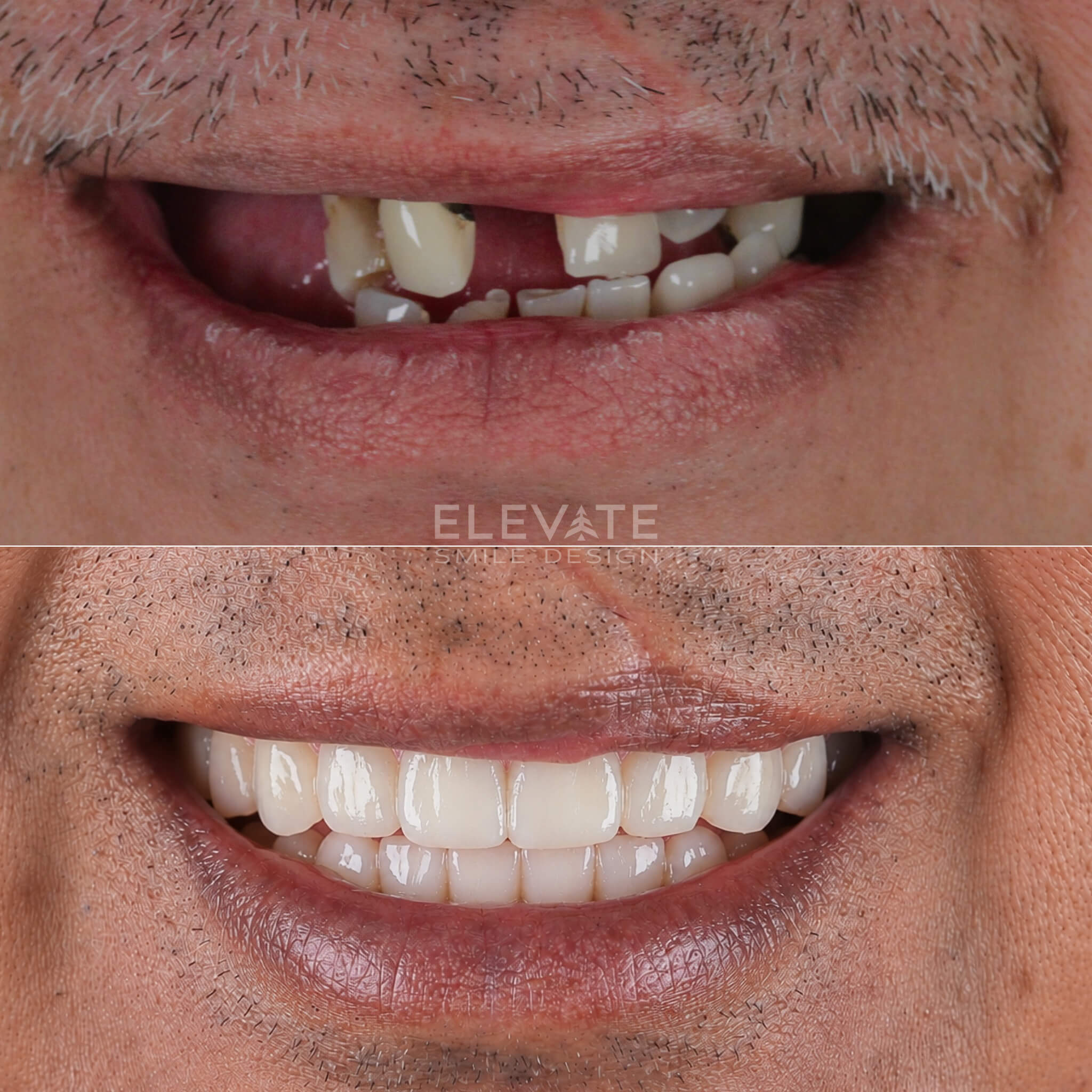 before/after smile transformation