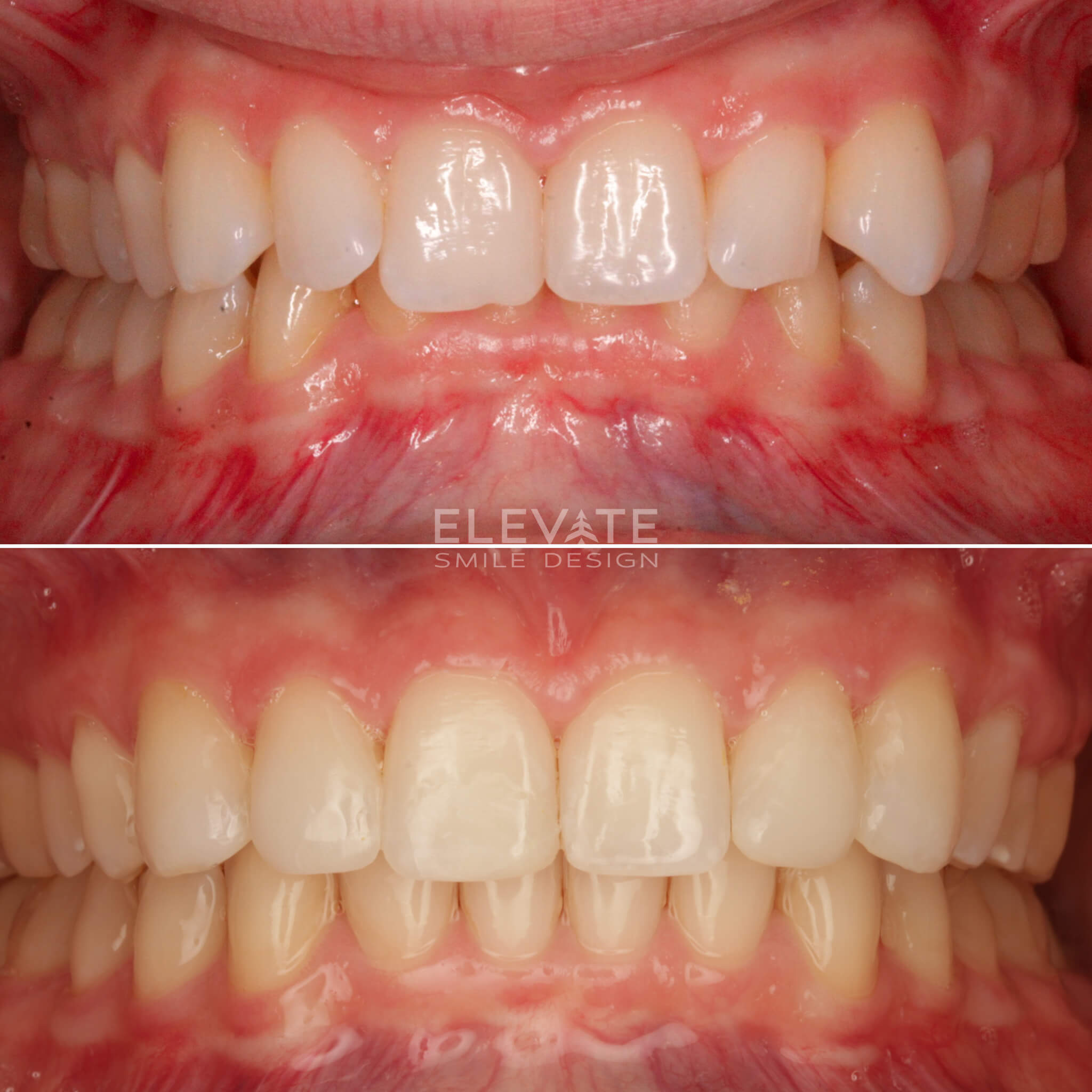 before/after orthodontic smiles
